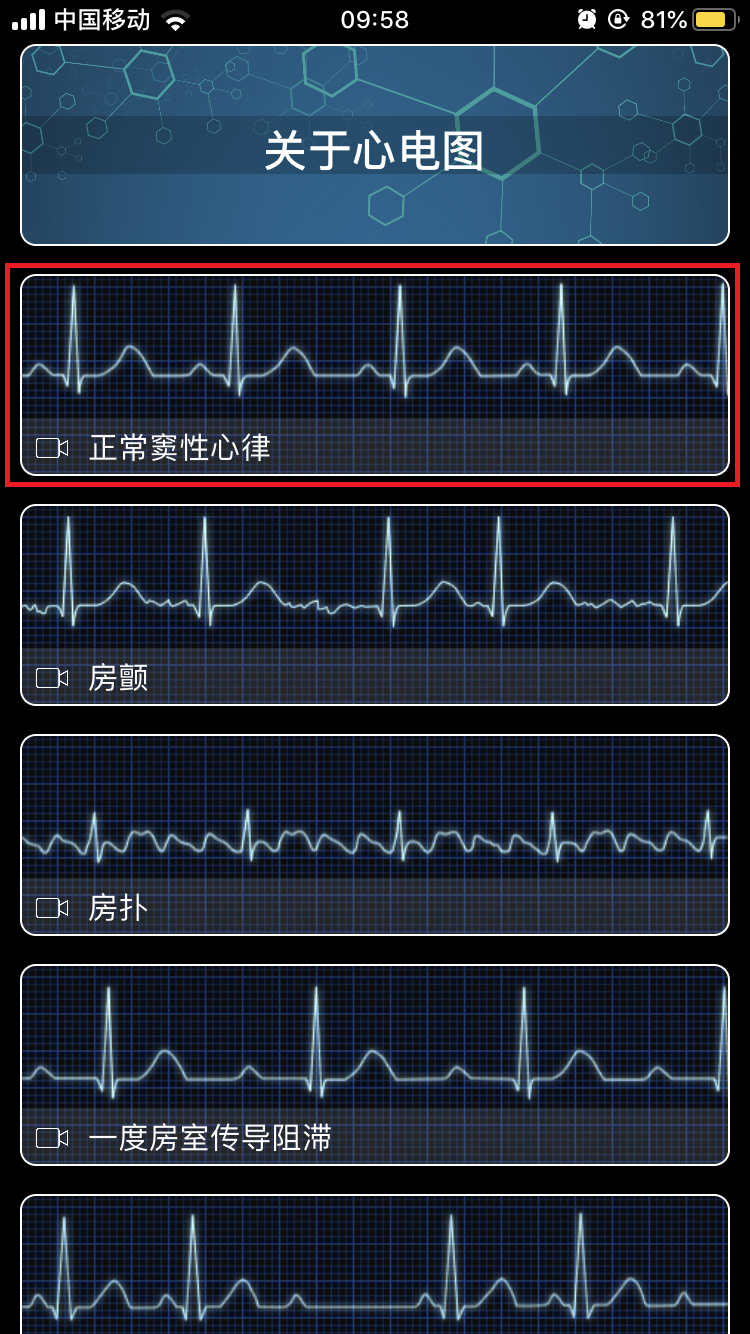 心电图截图